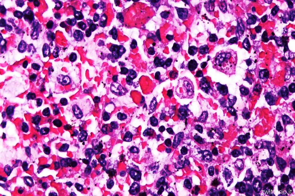 Microscopia Eritrociti Macrofagi Linfoistiocitosi Ematofagica Sindrome Macrofagica